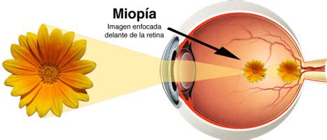 miopía 4